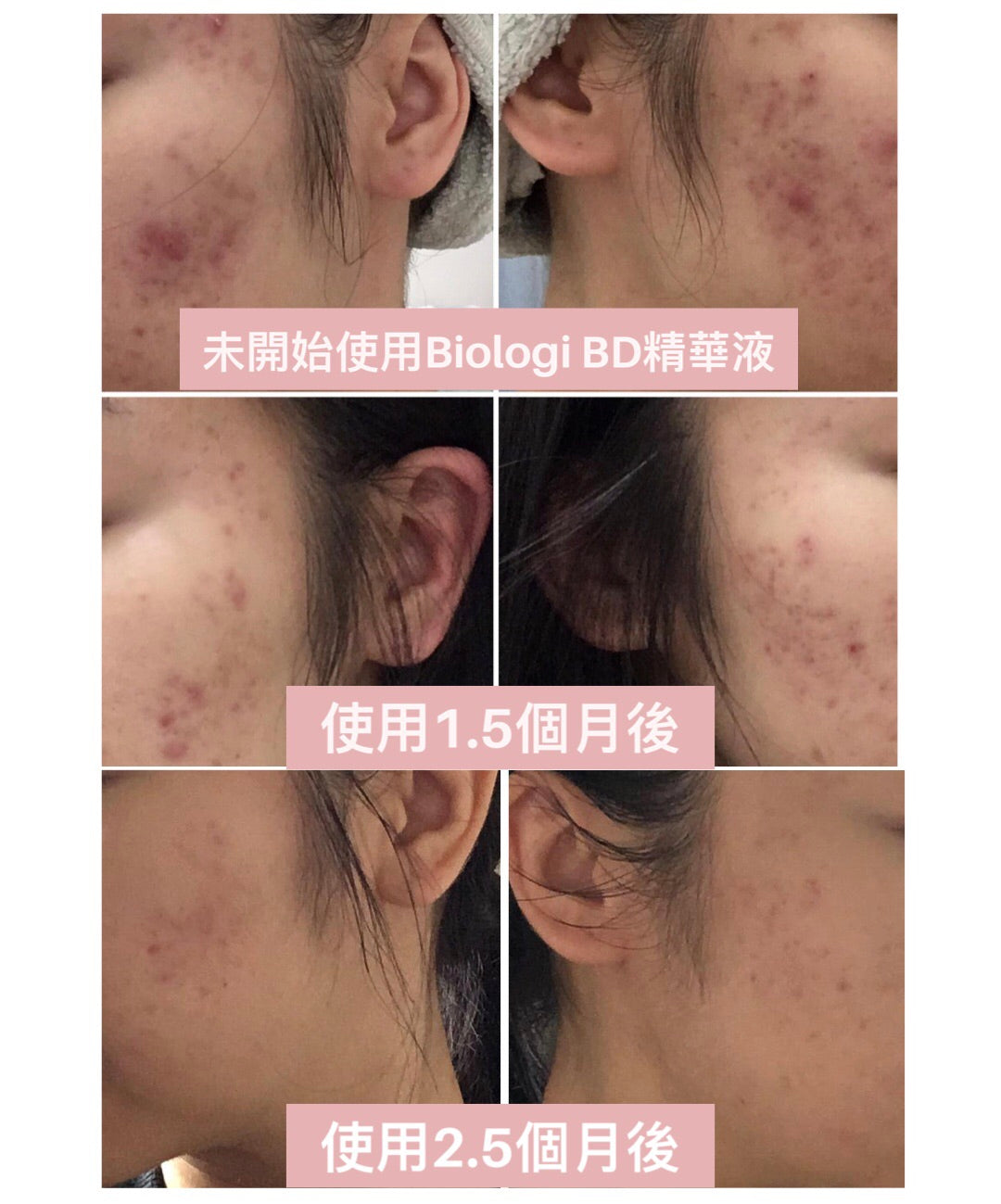 BIOLOGI【Bd】亮白去痘臉部活性精華液 Luminosity Face Serum